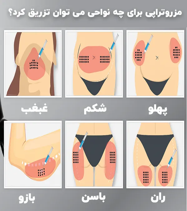 مزوتراپی برای چه نواحی می توان تزریق کرد؟