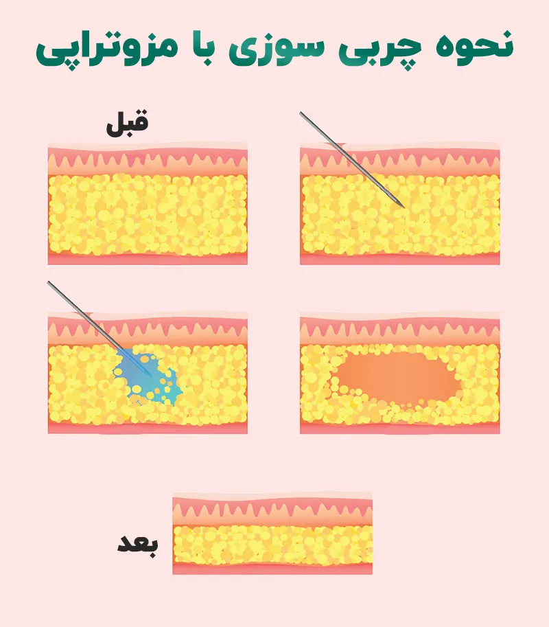 نحوه چربی سوزی با مزوتراپی