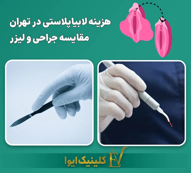 هزینه لابیاپلاستی در تهران