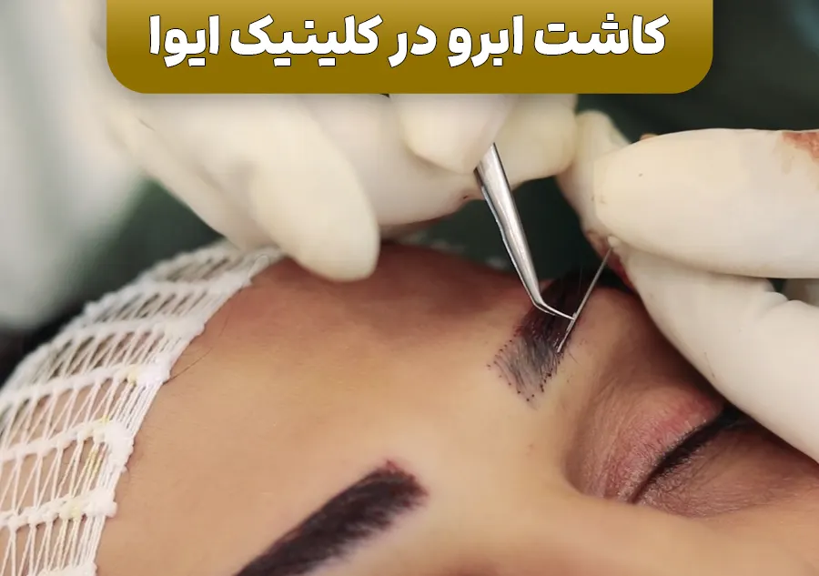 کلینیک کاشت ابرو