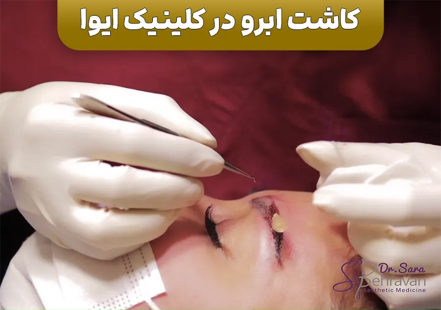 کلینیک کاشت ابرو
