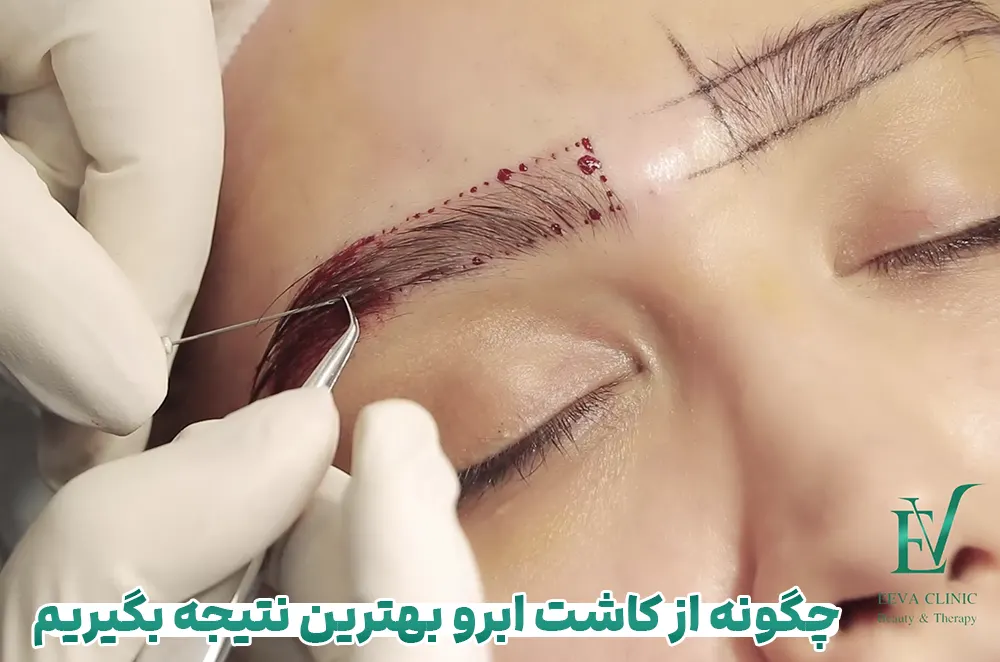 کاشت ابرو با بهترین نتیجه