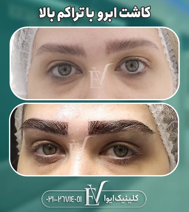کاشت ابرو با تراکم بالا