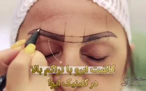 کاشت ابرو با تراکم بالا