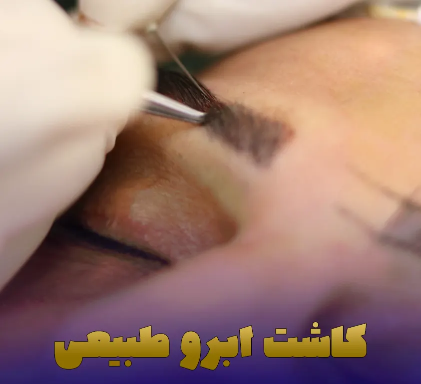 کاشت ابرو طبیعی