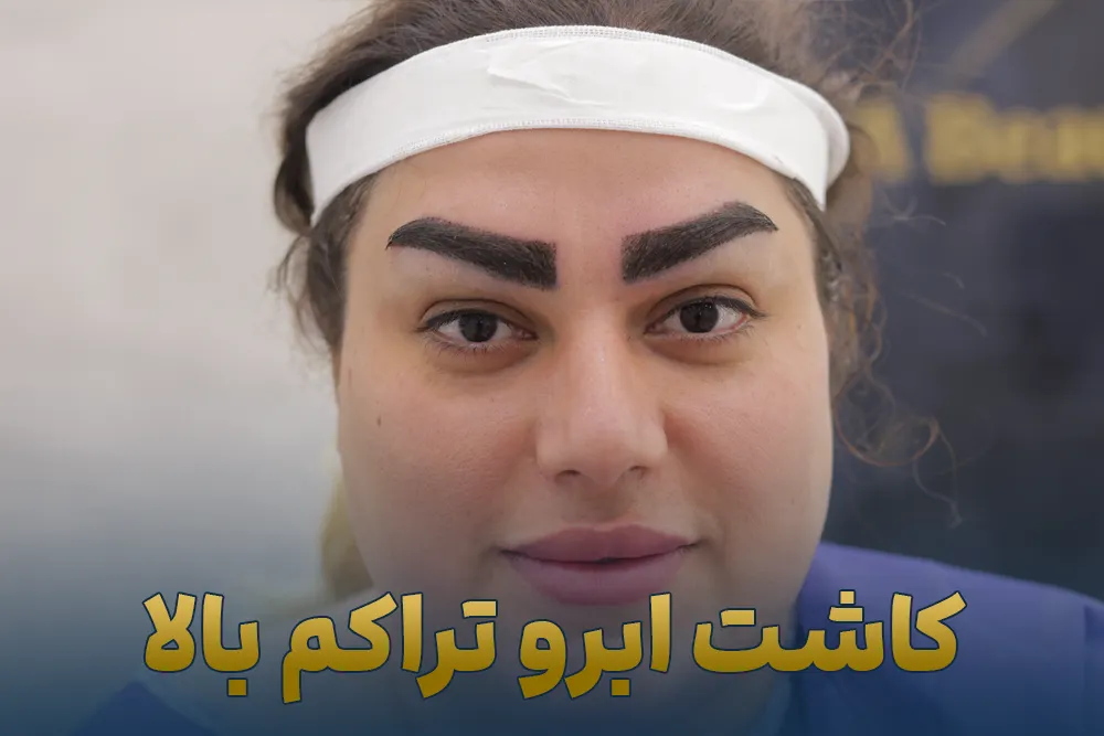 کاشت ابرو تراکم بالا