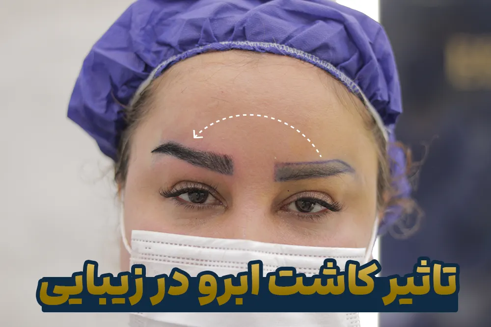 کاشت ابرو