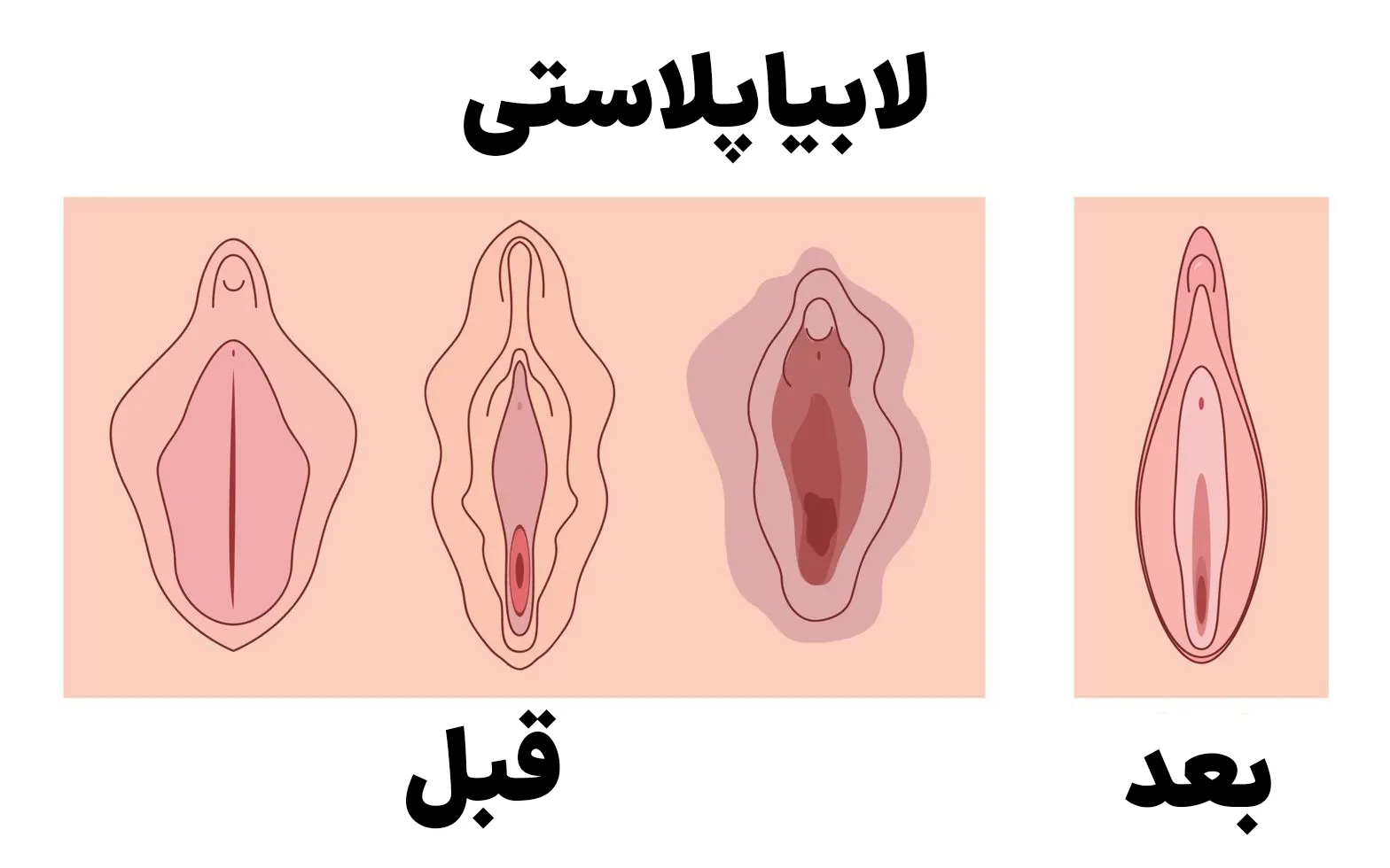 عکس و فیلم قبل و بعد از عمل لابیاپلاستی