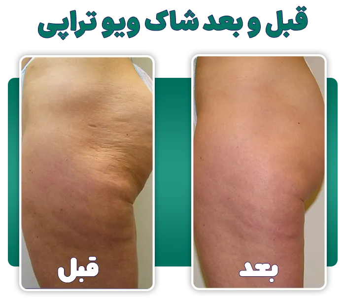 قبل و بعد سلولیت با شاک ویو