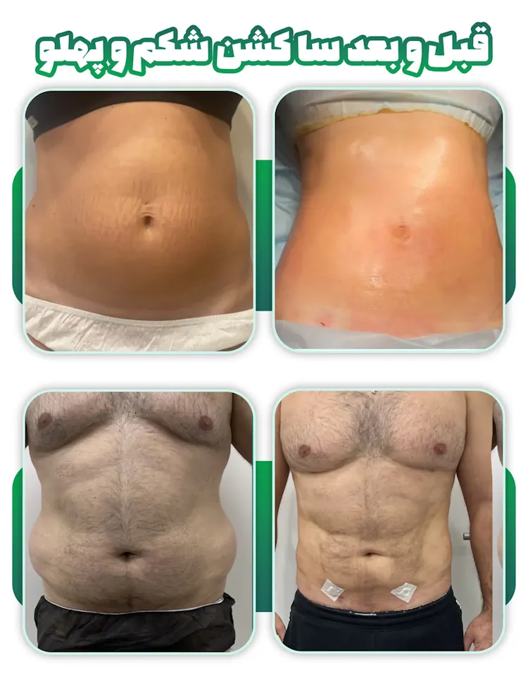 قبل و بعد لیپوساکشن