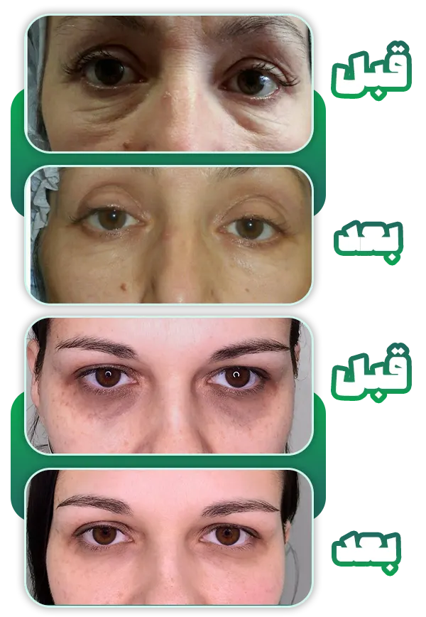 قبل و بعد کربوکسی تراپی