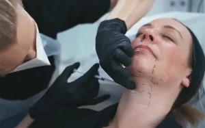 مزوتراپی غبغب