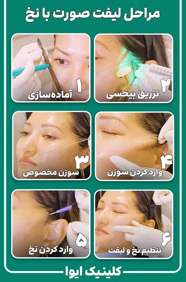 مراحل لیفت صورت با نخ