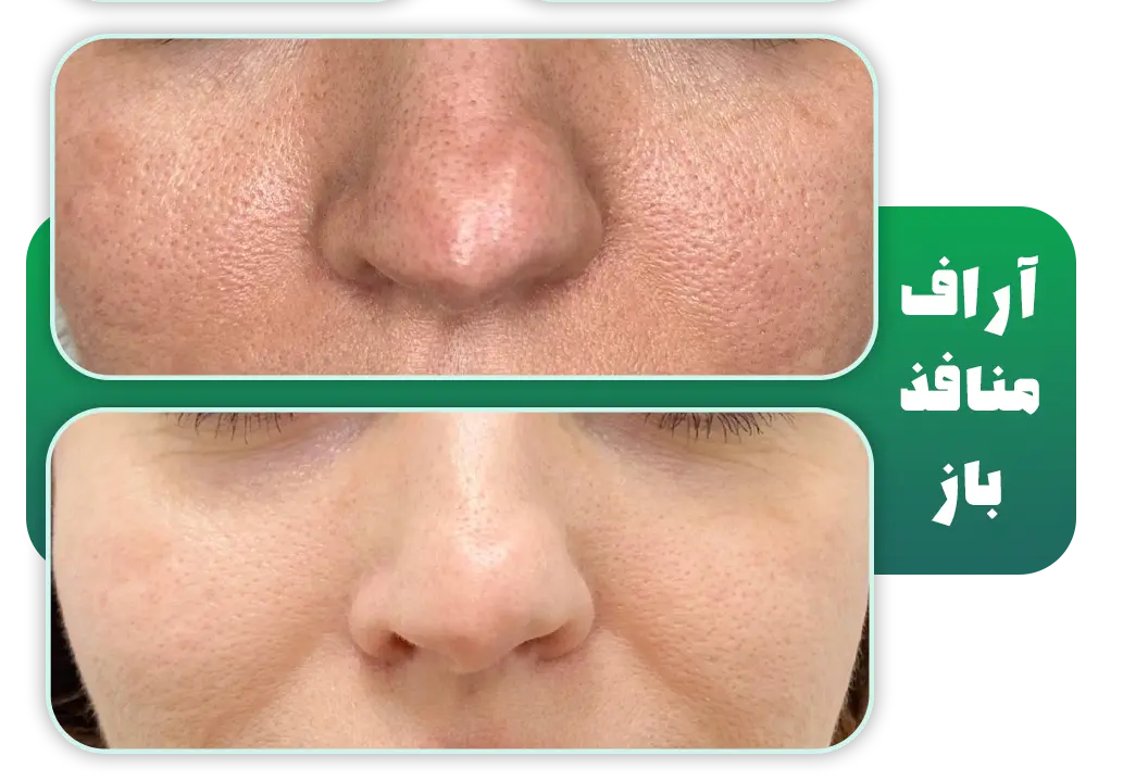 درمان منافذ باز پوست با آر اف فرکشنال