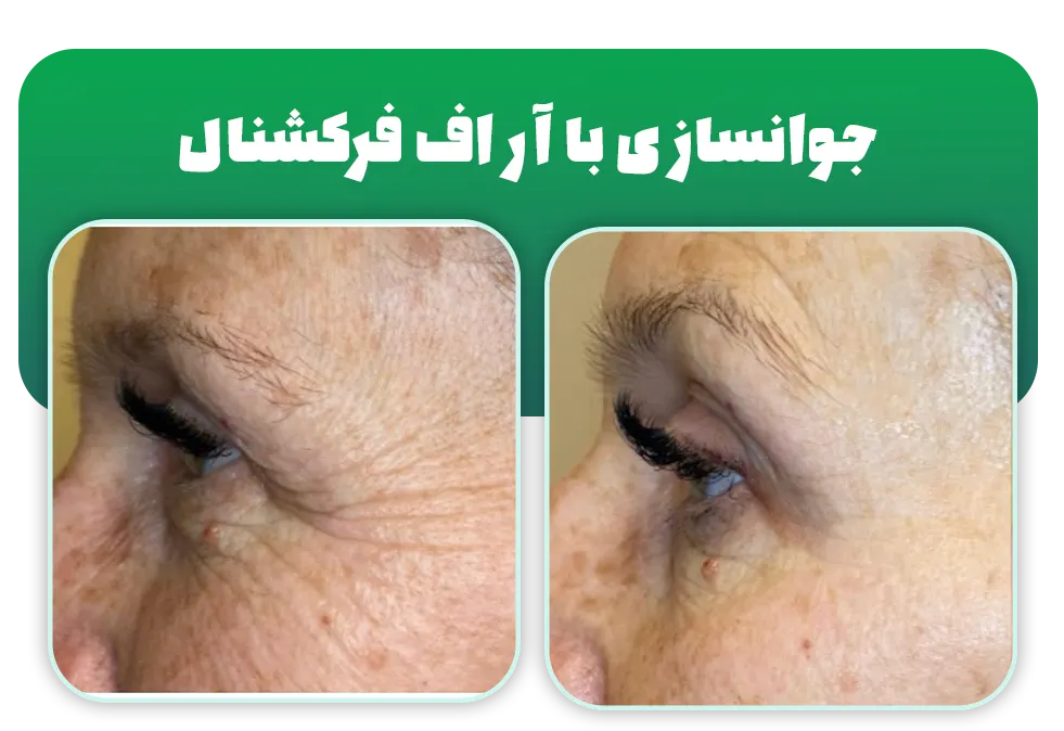 رفع چین و چروک آر اف فرکشنال