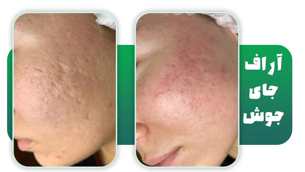 آر اف فرکشنال برای جای جوش