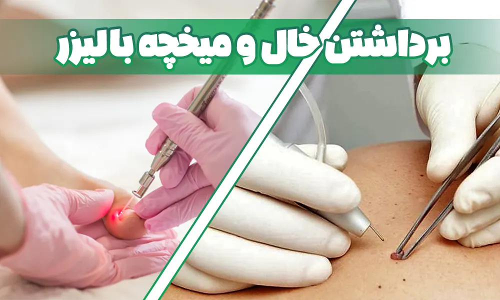 برداشتن خال و میخچه با لیزر co2 فرکشنال
