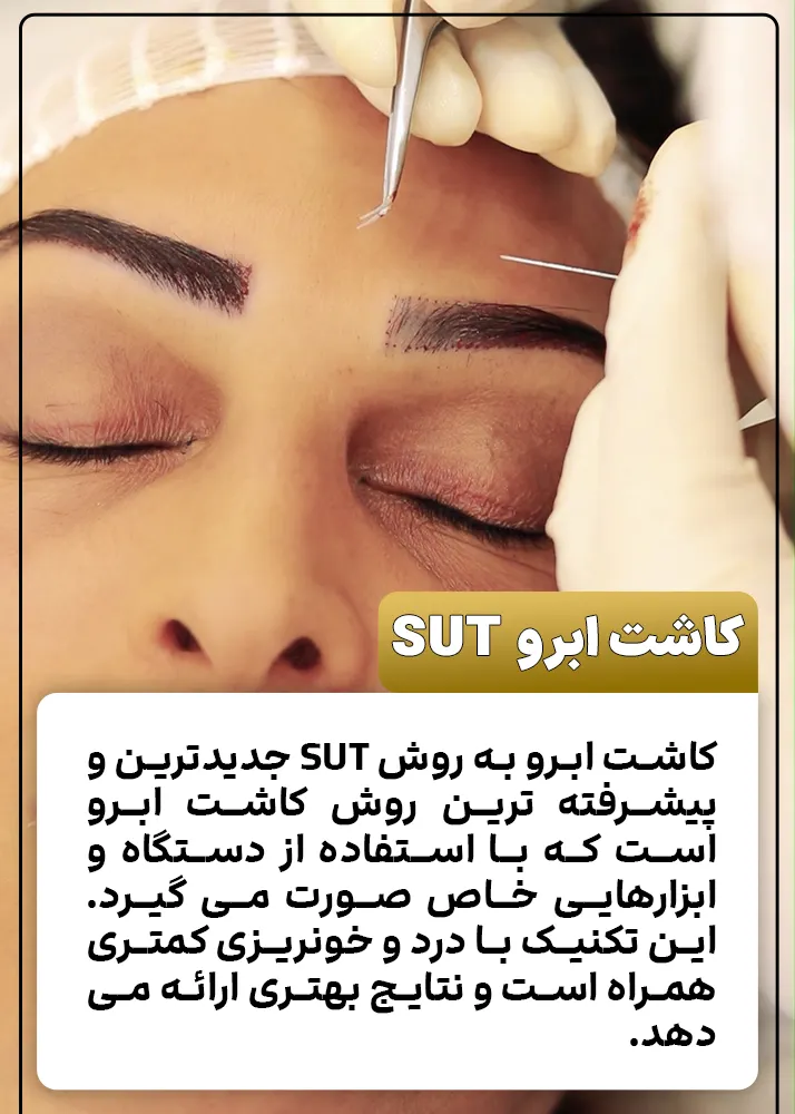کاشت ابرو به روش SUT