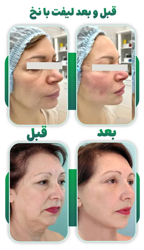 قبل و بعد لیفت صورت با نخ