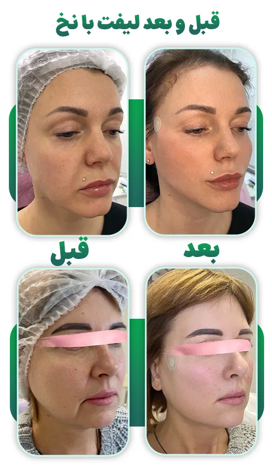 قبل و بعد لیفت با نخ