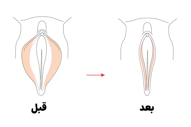 لابیاپلاستی