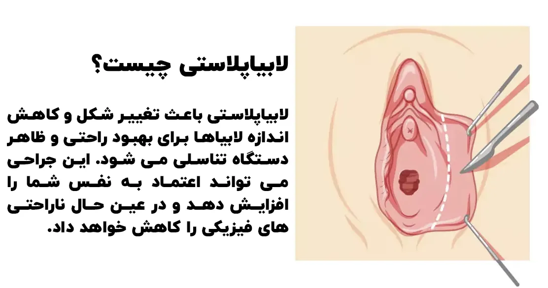 لابیاپلاستی