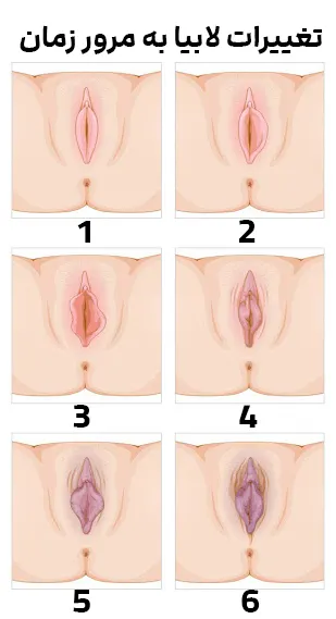 بزرگ شدن لابیا