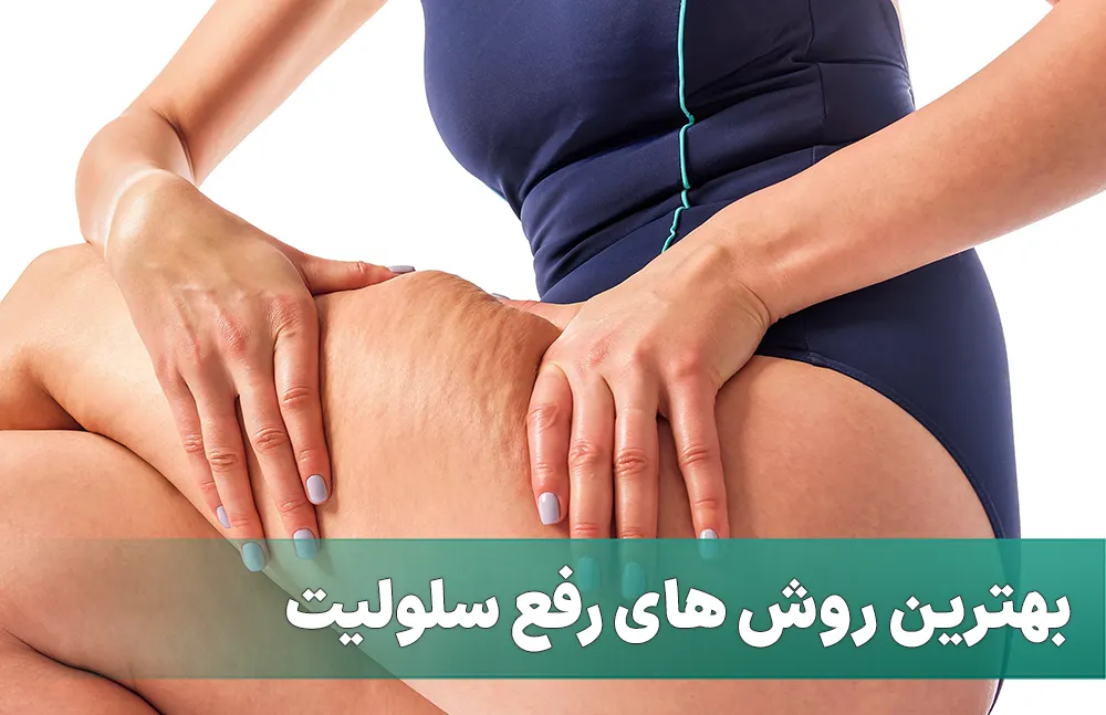 بهترین روش های رفع سلولیت