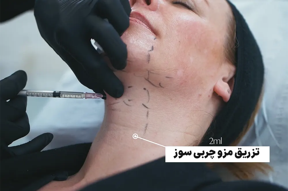 مزو چربی سوز غبغب