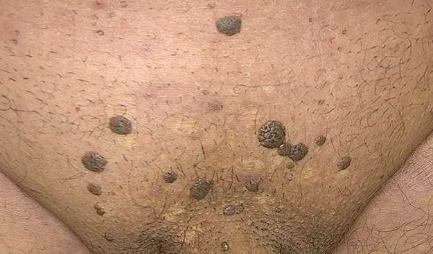 زگیل تناسلی