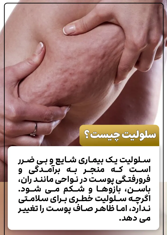 سلولیت چیست