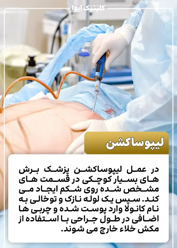 لیپوساکشن