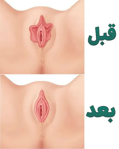 لابیاپلاستی