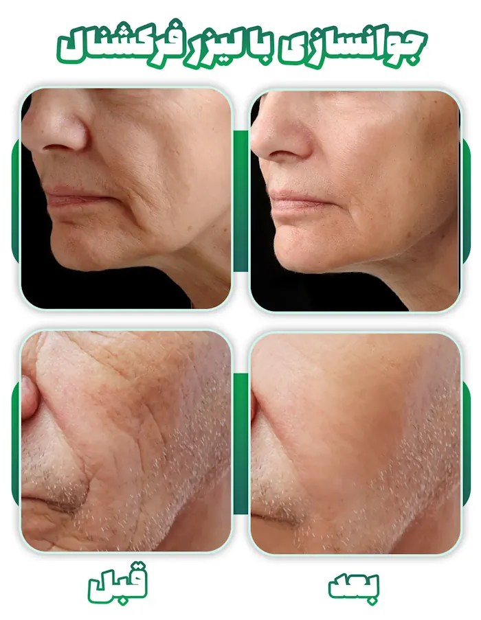 قبل بعد لیزر فرکشنال