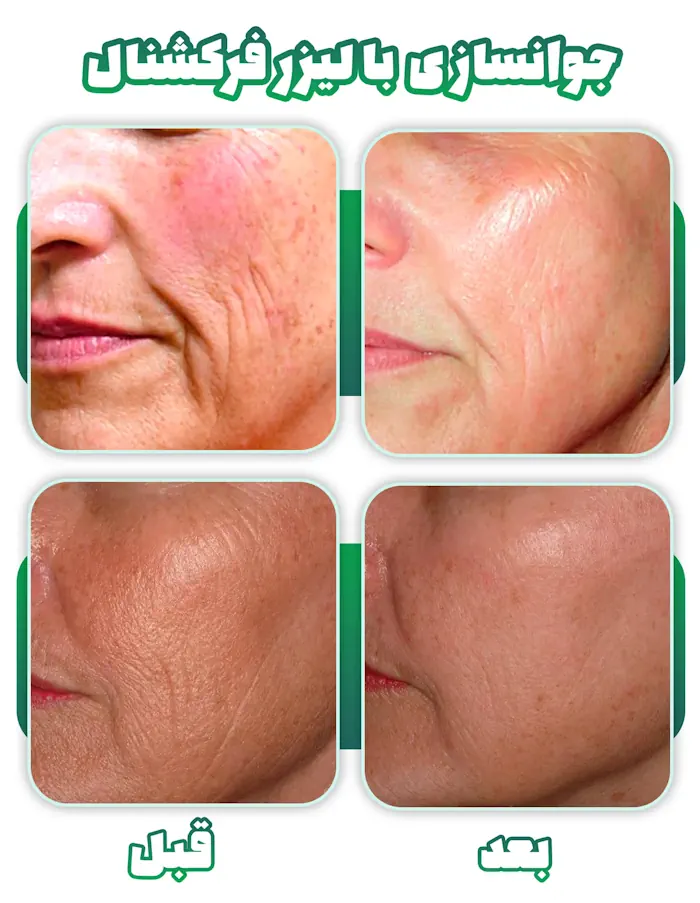 قبل بعد لیزر فرکشنال