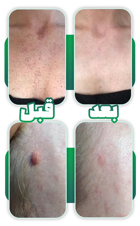 قبل بعد لیزر خال