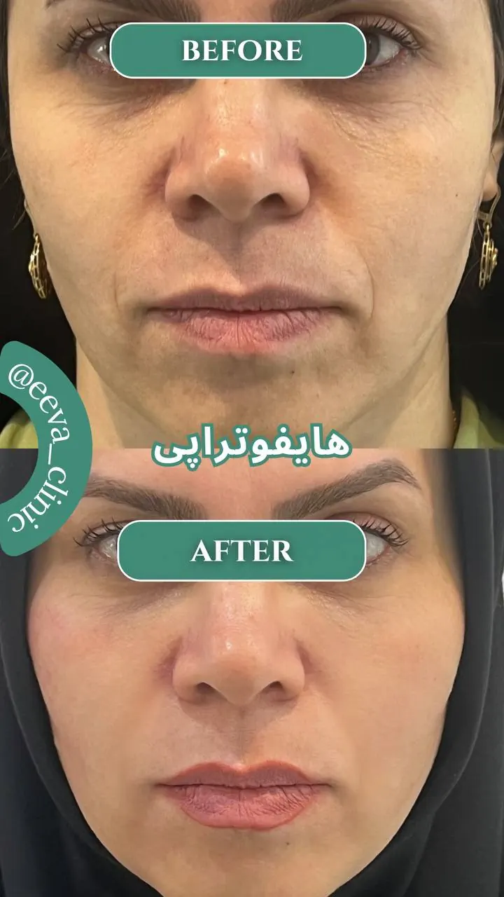 قبل و بعد هایفو صورت