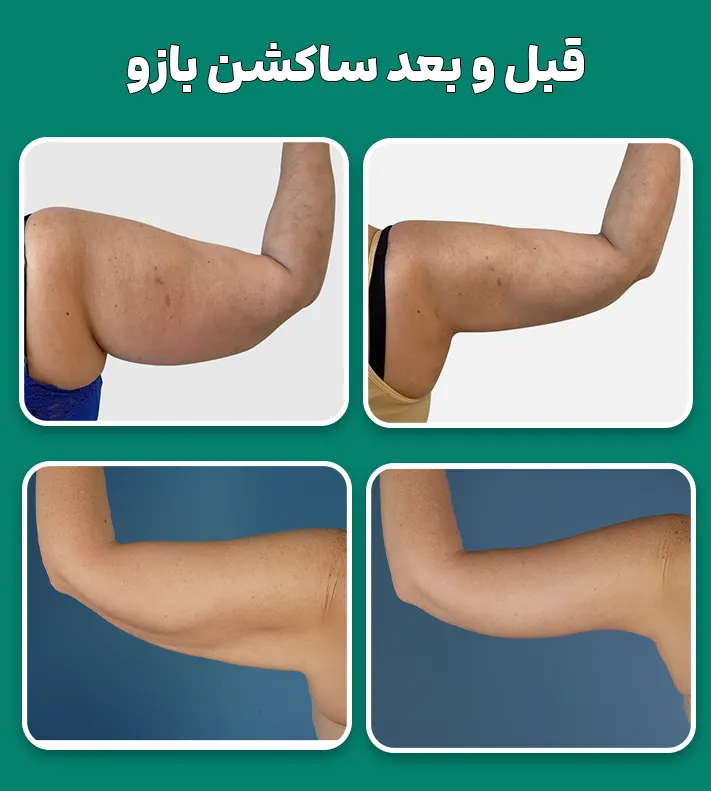قبل و بعد ساکشن بازو