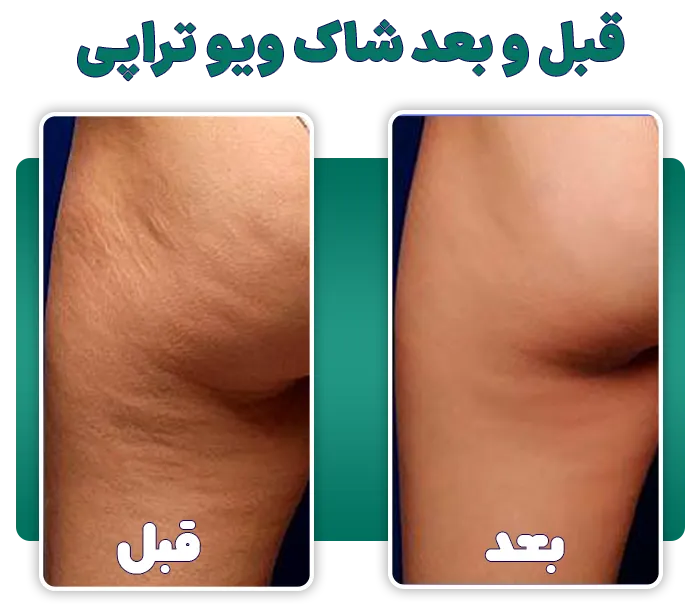 قبل و بعد سلولیت با شاک ویو