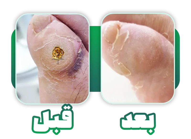 قبل و بعد لیزر میخچه