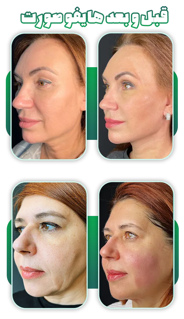 قبل و بعد هایفو صورت