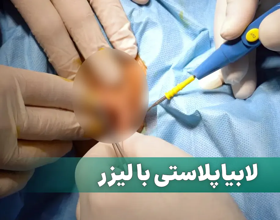 لابیاپلاستی با لیزر