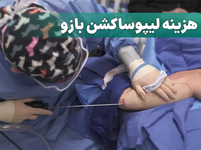 هزینه لیپوساکشن بازو