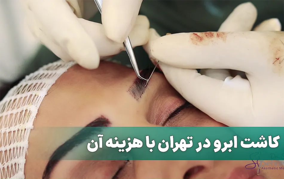 کاشت ابرو در تهران