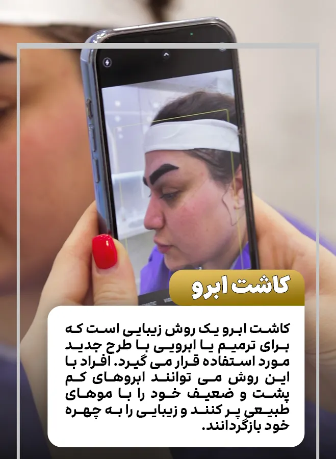 کاشت ابرو چیست