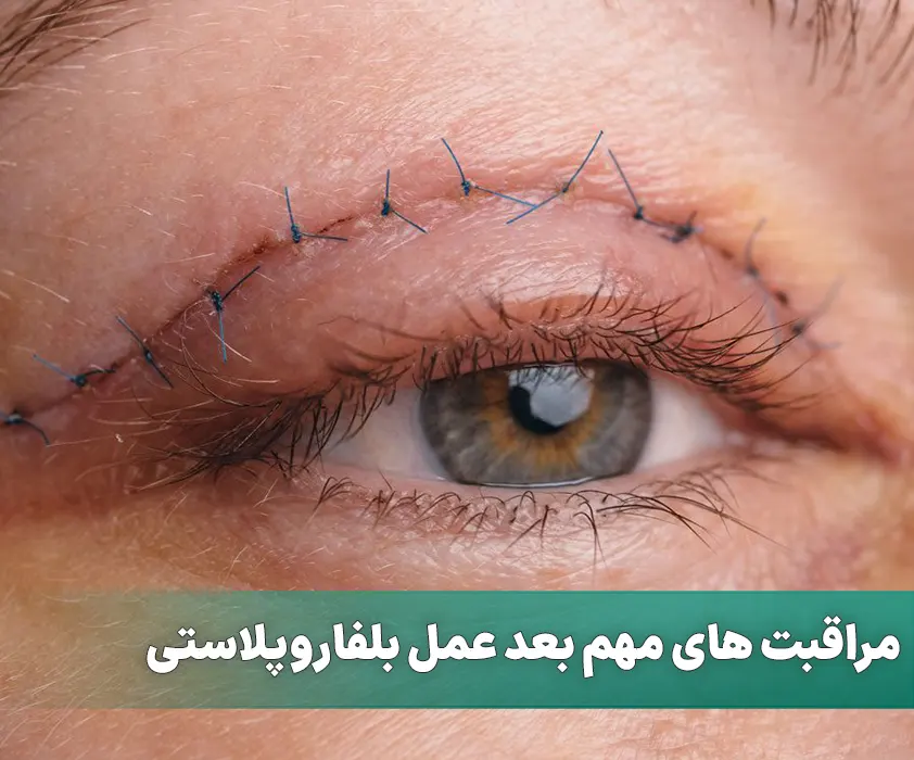 مراقبت های مهم بعد عمل بلفاروپلاستی