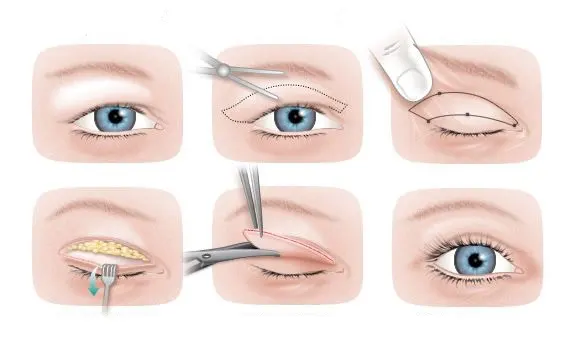 بلفاروپلاستی