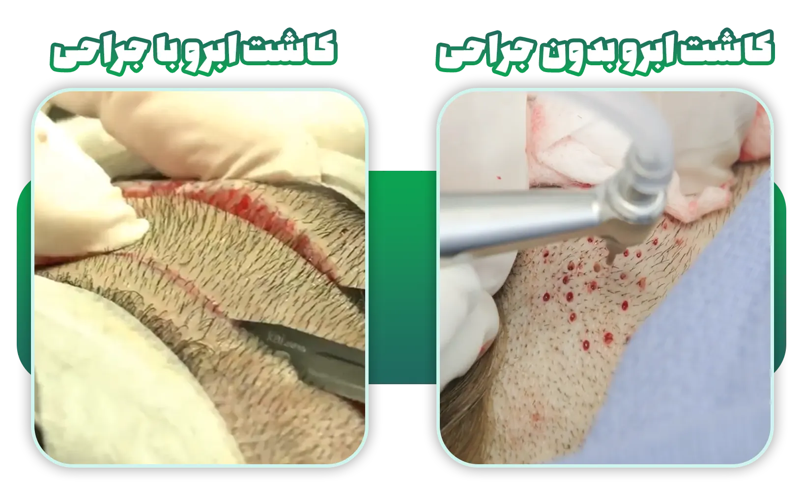 کاشت ابرو بدون جراحی