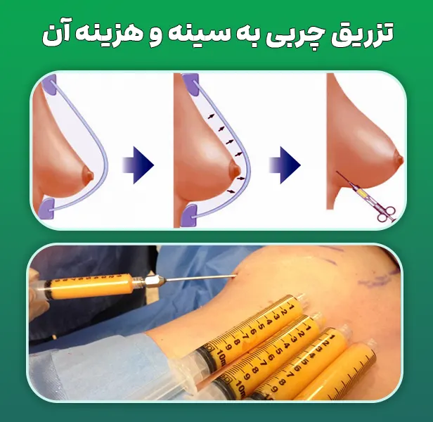 تزریق چربی سینه