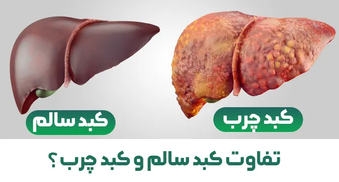 کبد چرب